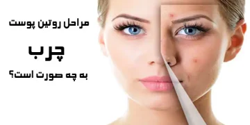 روتین پوست چرب به چه صورت است ؟