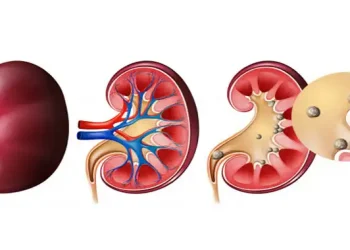 علائم و روش مفید برای دفعه سنگ کلیه چیست؟