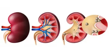 علائم و روش مفید برای دفعه سنگ کلیه چیست؟