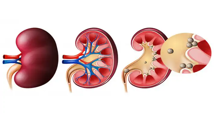 علائم و روش مفید برای دفعه سنگ کلیه چیست؟