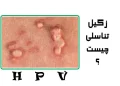 زگیل تناسلی