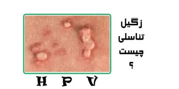 زگیل تناسلی