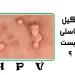 زگیل تناسلی