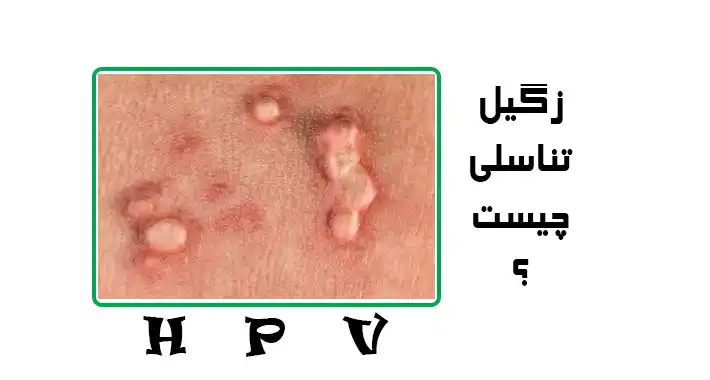 زگیل تناسلی