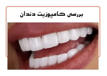 کامپوزیت دندان