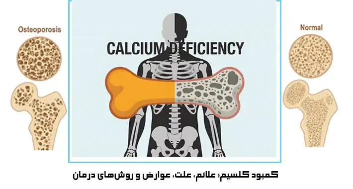 کمبود کلسیم