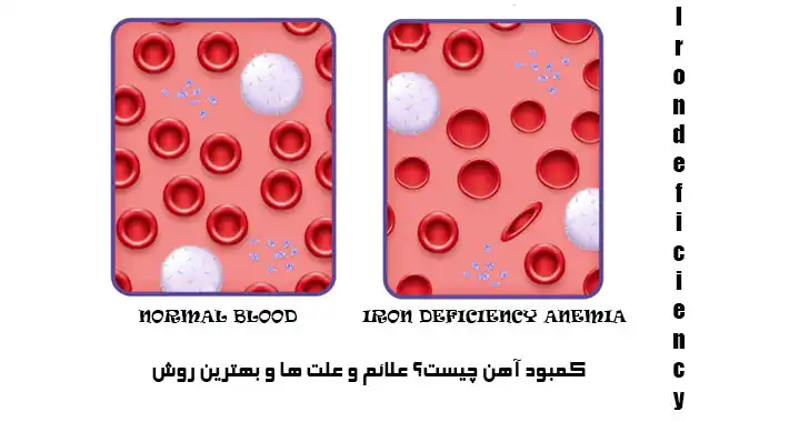 کمبود آهن
